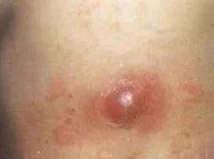柞精病楝7：了解柞精病的病因、症状及治疗方法，探寻其对人类健康的影响与预防策略